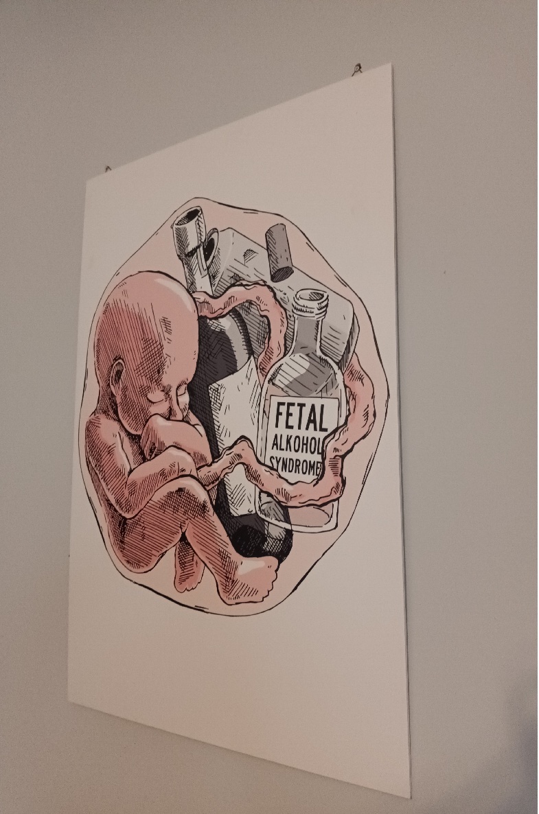 Grafika ukazująca niebezpieczeństwa wynikające ze spożycia alkoholu w ciąży. Na grafice przedstawiono dziecko, związane pępowiną z butelką w&oacute;dki, puszką piwa i butelką wina. 